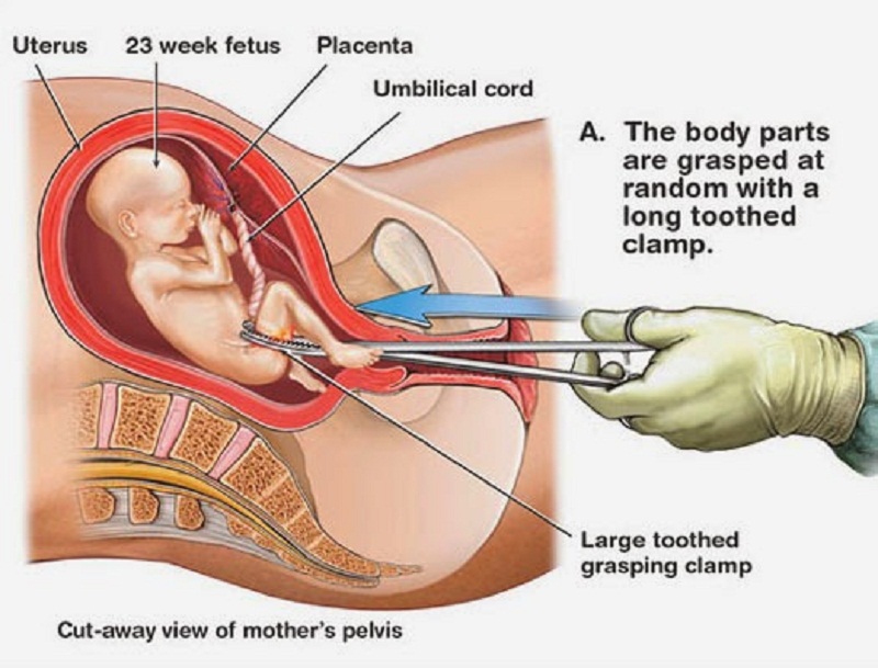 Abortion process